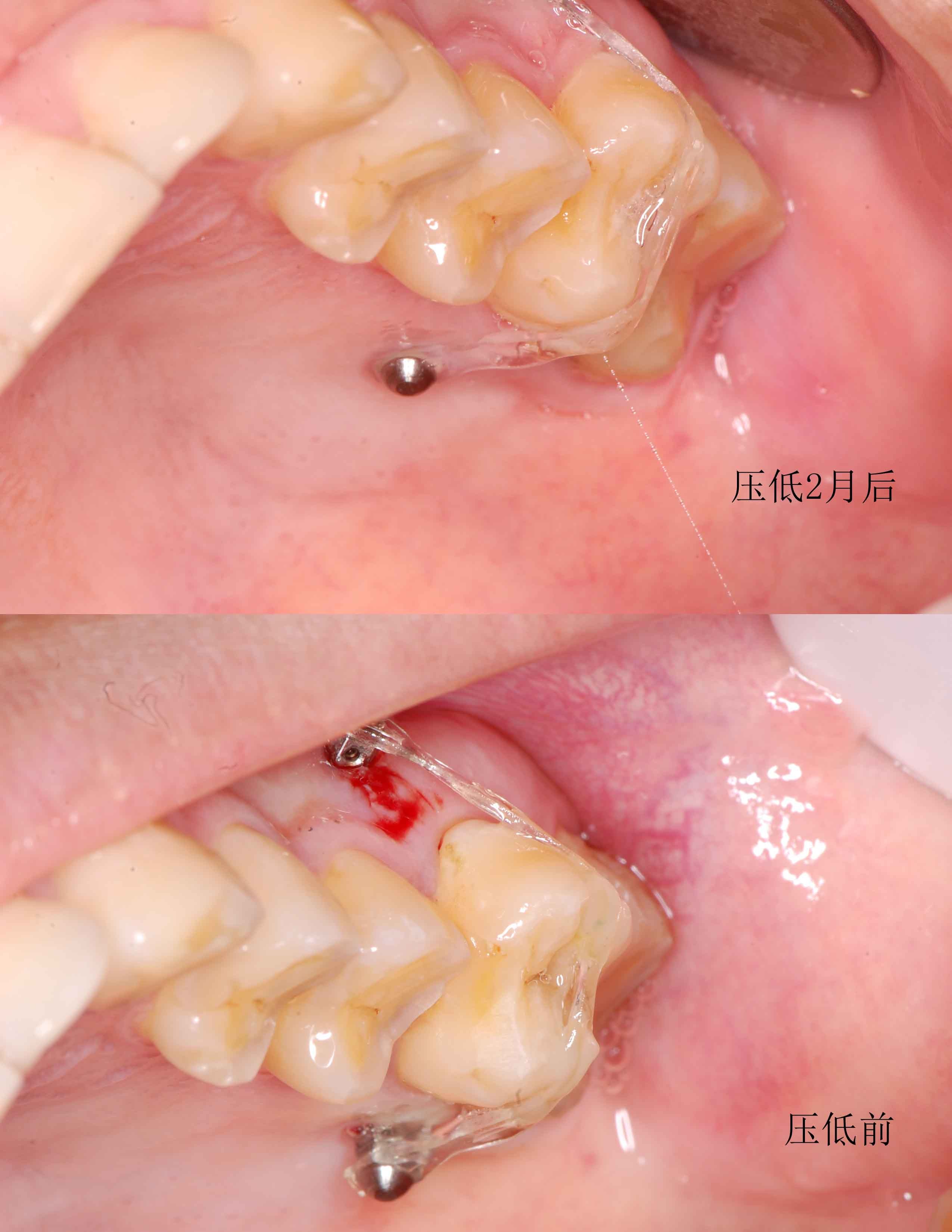 通过正畸支抗钉的方法来压低伸长的磨牙